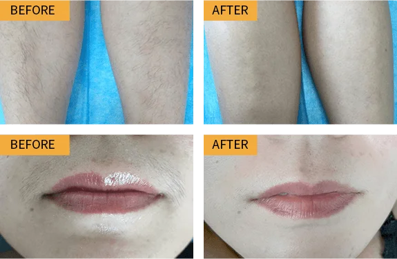 Before & After Treatment