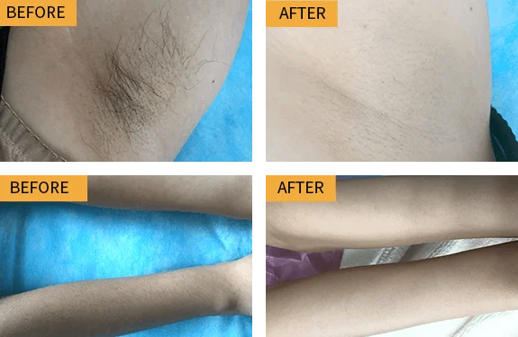 Before & After Treatment