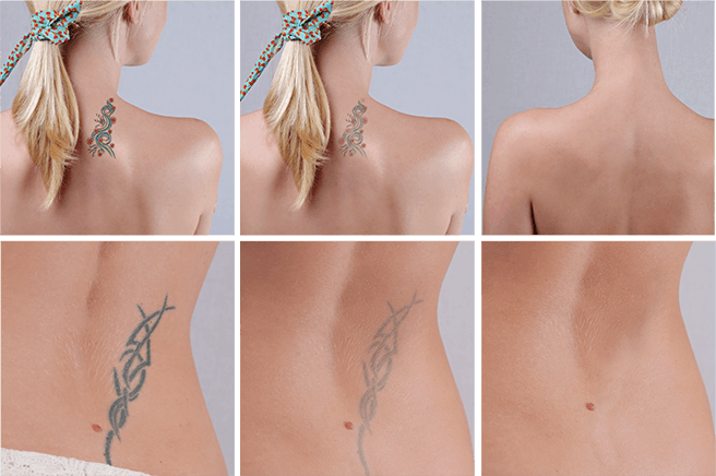 DualPico Laser Tattoo Removal