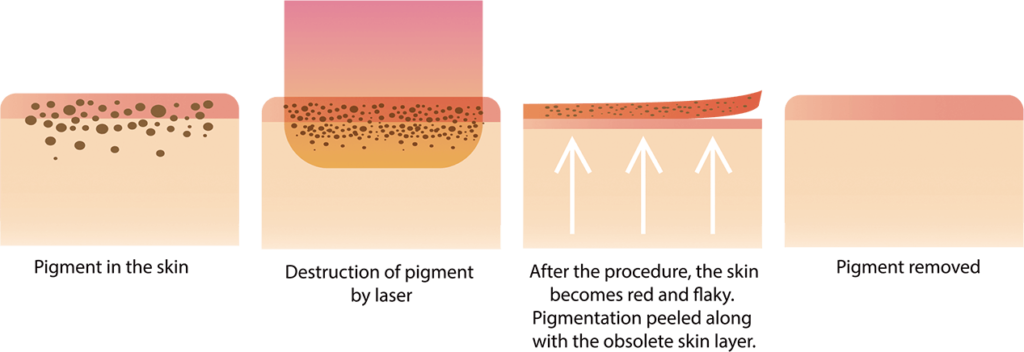 How Does DualPico Picosecond Laser System Work