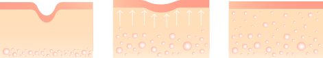 Mechanism of Action of RF Instrument