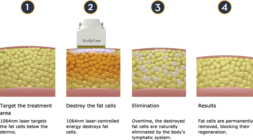 Mechanism of Action of SculpLase Diode Laser Lipolysis