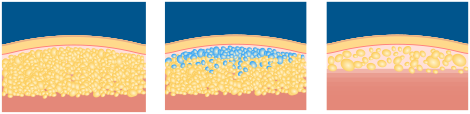 Principle of RF Fat Dissolving