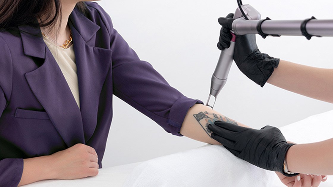 Laser Tattoo Removal: Witness the Stunning Before and After