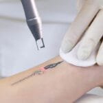 Essential Aftercare for Pico Laser Tattoo Removal