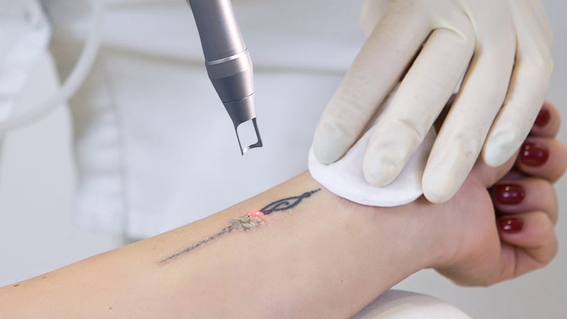 Essential Aftercare for Pico Laser Tattoo Removal