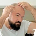 Smooth Scalp Ahead: Laser Hair Removal for a Bald Head