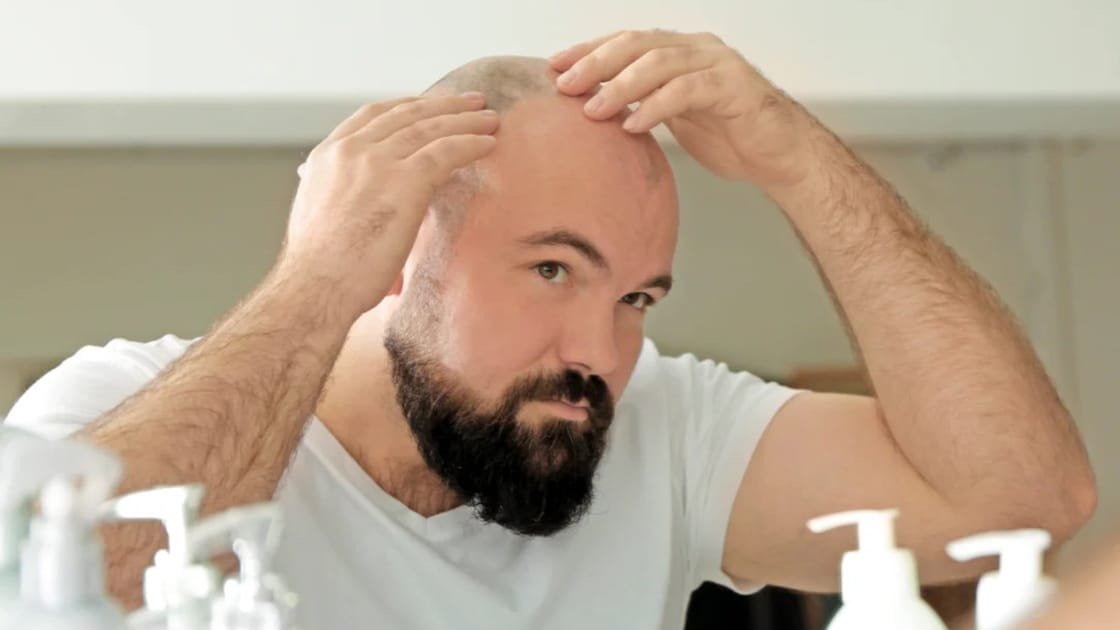 Smooth Scalp Ahead: Laser Hair Removal for a Bald Head