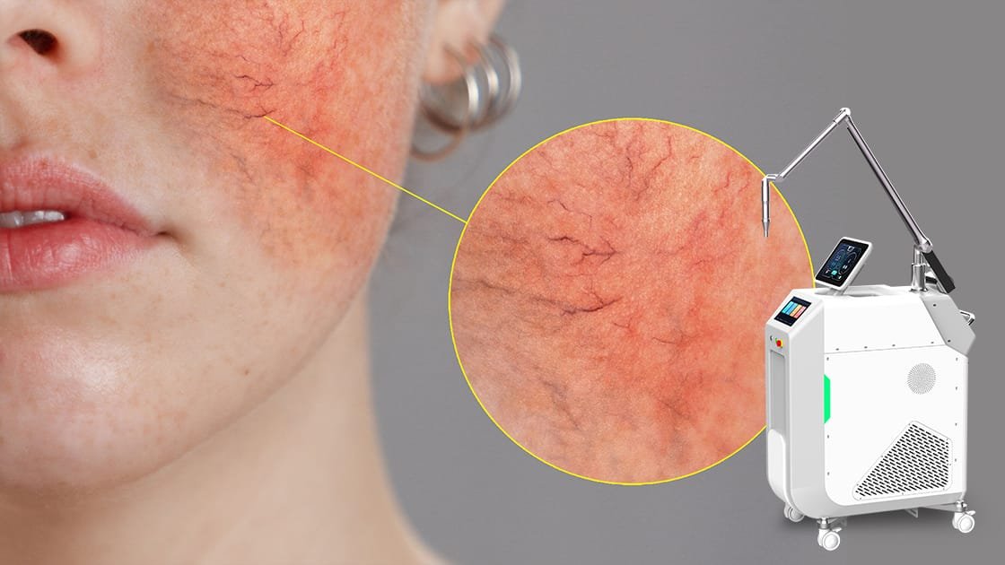 Flawless Skin Starts Here: Pico Laser for Capillary Repair