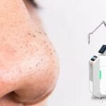 Get Clearer Skin: Picosecond Laser for Comedones