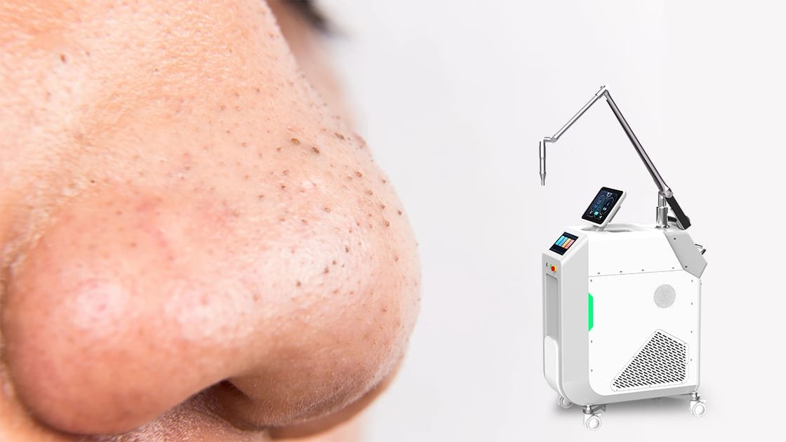 Get Clearer Skin: Picosecond Laser for Comedones