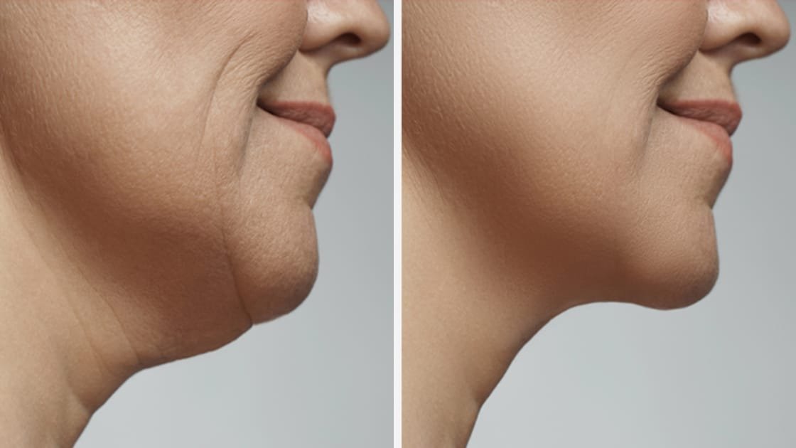 Chin Up! Boost Your Confidence with Laser Lipolysis