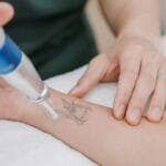 Can Pico Lasers Completely Remove a Tattoo?