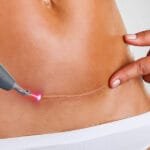 Can Picosecond Laser Really Minimize Surgical Scars?