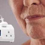 Youthful Lips in Minutes: Radiofrequency for Smoker’s Lines