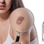 Bumpy Scars, Be Gone! How Pico Laser Smooths Out Hypertrophic Scars