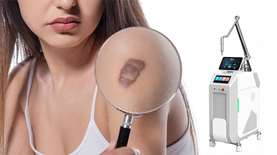 Bumpy Scars, Be Gone! How Pico Laser Smooths Out Hypertrophic Scars