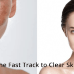 Pico Laser for Hyperpigmentation: Your Shortcut to Clear Skin