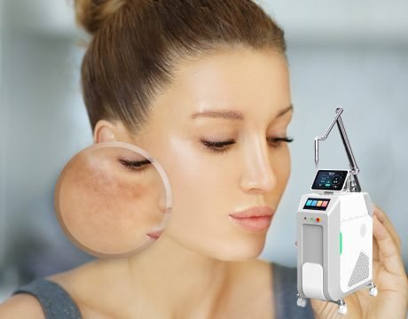 Laser Treatments for Melasma