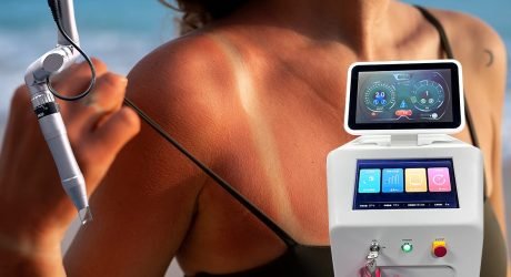 Banish Summer Sunburn with TitanPico Laser