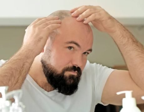 Laser hair removal for bald head