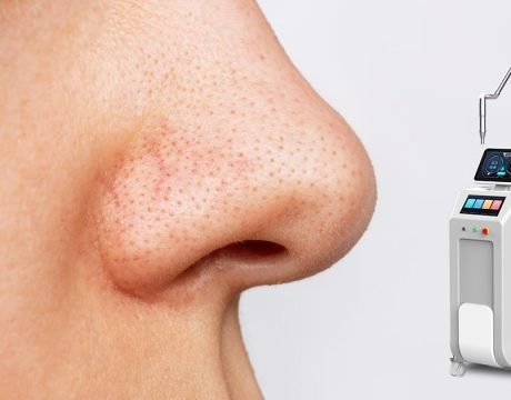 Pico Laser for Blackheads