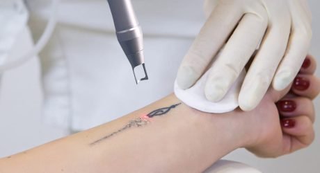 pico laser tattoo removal