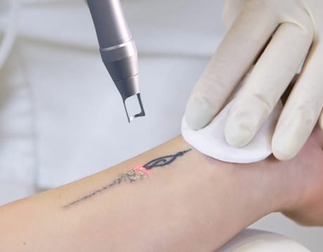 pico laser tattoo removal